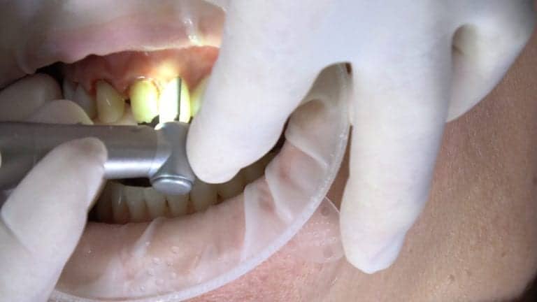 Veneer Removal with Dental Laser