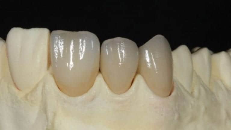 Press Lithium Disilicate Restorations in Your Dental Practice