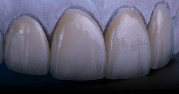 Human teeth covered with imperceptible porcelain veneers