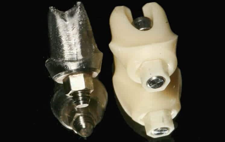 Dental Implant 101 & Types Of Materials | Keating Dental Lab