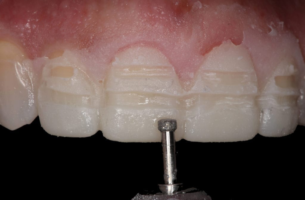 The HornbrookKeating preparation/provisional Kit Keating Dental Lab