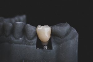 white dental implant on black prop teeth