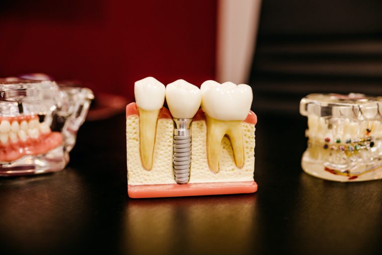 implant model displayed in a dentist's desk showing the replica of 2 teeth with 1 implant crown between them