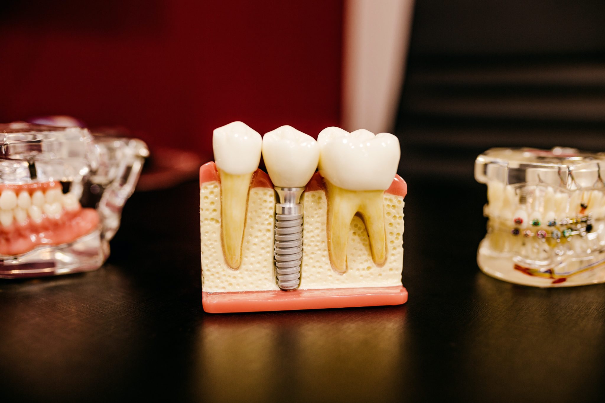 implant model displayed in a dentist's desk showing the replica of 2 teeth with 1 implant crown between them