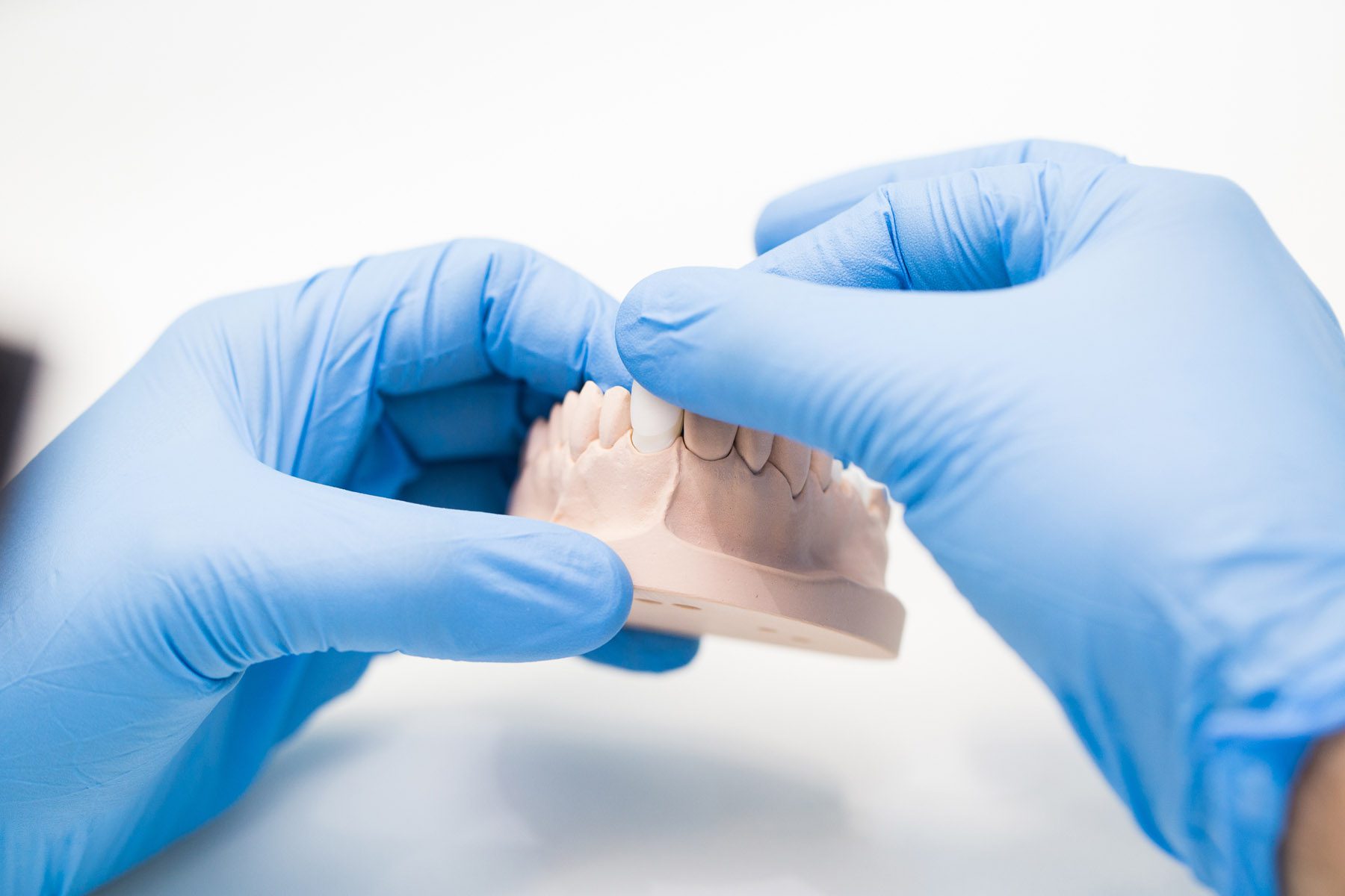 Close up shot of dentist's technician's hands working on a prosthetic tooth, measuring the crown of a tooth.