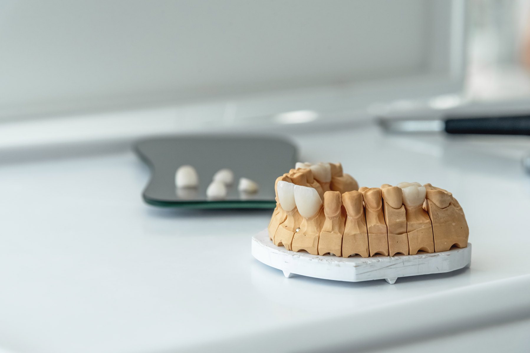 Artificial jaw with veneers and crowns, on the work table in the dental laboratory. Dentistry and treatment concept.